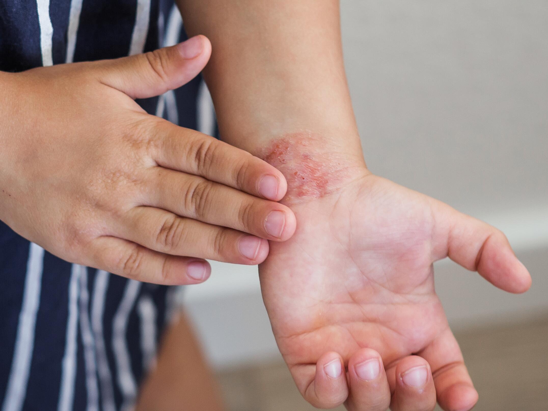 bouton d‘eczéma sur la main